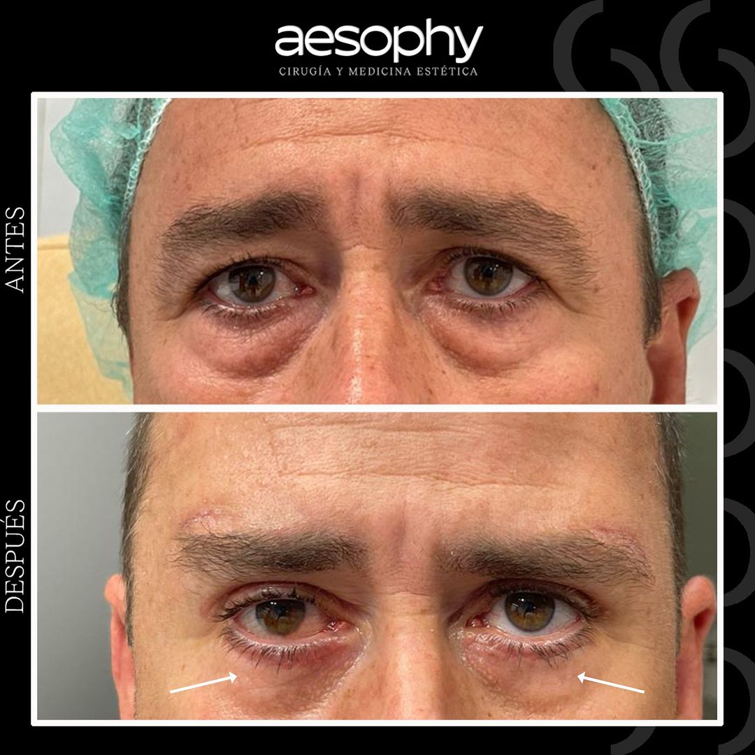 Blefaroplastia en Málaga: Recupera una Mirada Joven