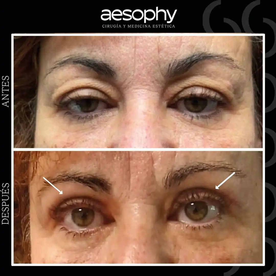 Blefaroplastia en Málaga: Recupera una Mirada Joven