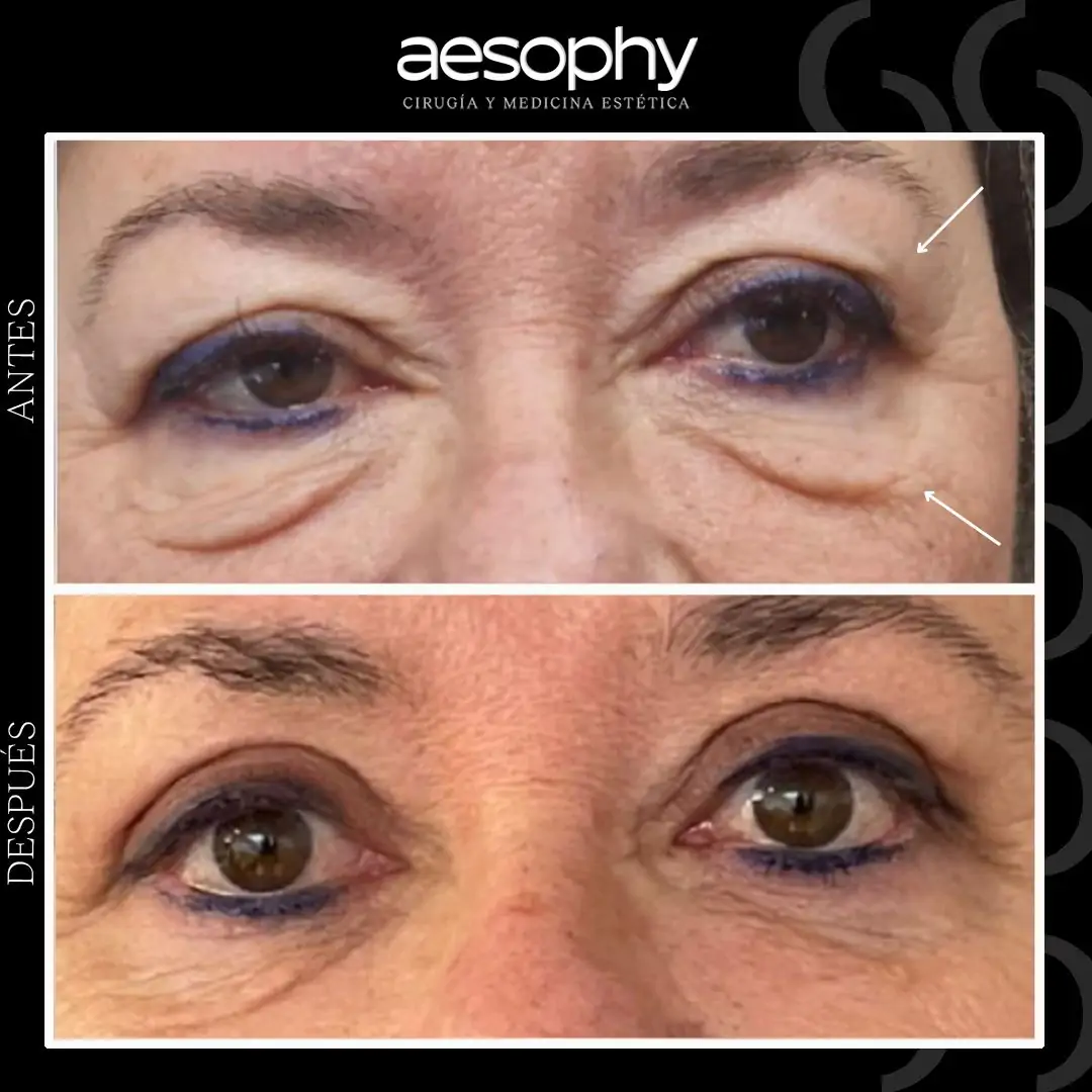 Blefaroplastia en Málaga: Recupera una Mirada Joven